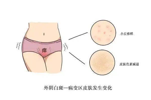 外阴白斑癌变的表现有哪些?